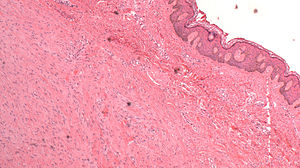 English: Skin with Scar Histology English: Skin with Scar Histology